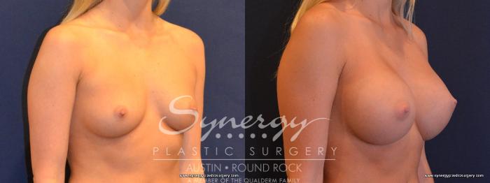Before & After Breast Augmentation Case 405 View #3 View in Austin, TX