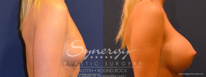 Before & After Breast Augmentation Case 405 View #4 View in Austin, TX