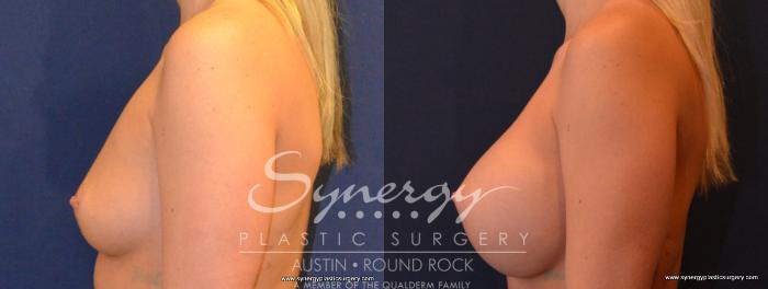 Before & After Breast Augmentation Case 405 View #5 View in Austin, TX