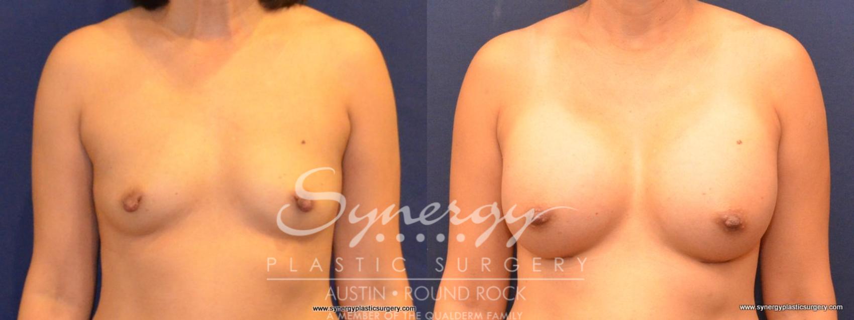 Before & After Breast Augmentation Case 408 View #1 View in Austin, TX