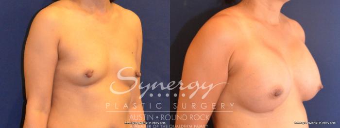 Before & After Breast Augmentation Case 408 View #3 View in Austin, TX