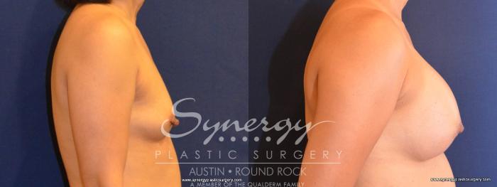 Before & After Breast Augmentation Case 408 View #4 View in Austin, TX
