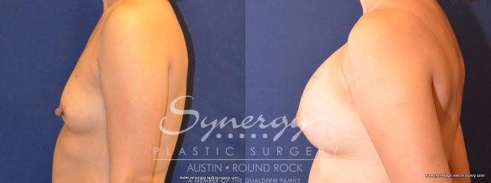 Before & After Breast Augmentation Case 408 View #5 View in Austin, TX