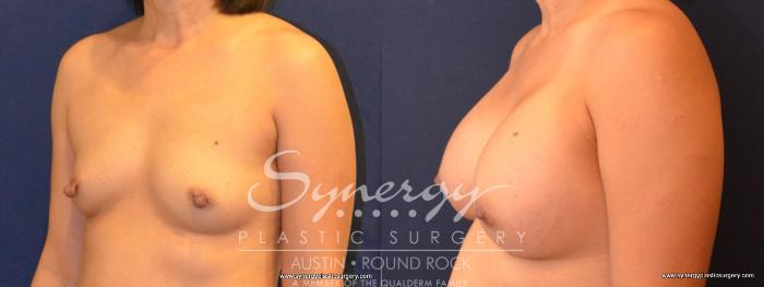 Before & After Breast Augmentation Case 408 View #6 View in Austin, TX