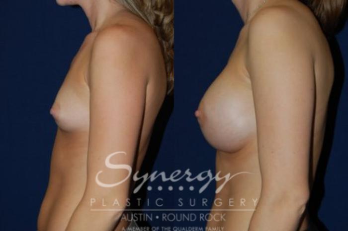 Before & After Breast Augmentation Case 41 View #1 View in Austin, TX