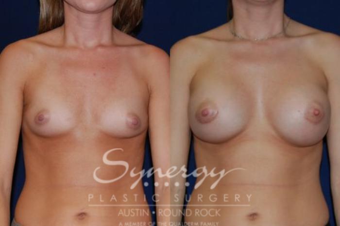Before & After Breast Augmentation Case 41 View #3 View in Austin, TX