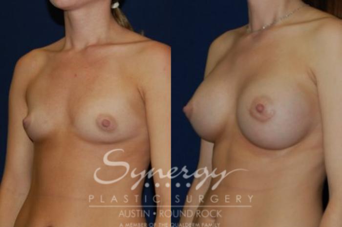 Before & After Breast Augmentation Case 41 View #4 View in Austin, TX