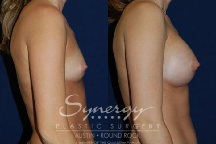 Before & After Breast Augmentation Case 41 View #5 View in Austin, TX