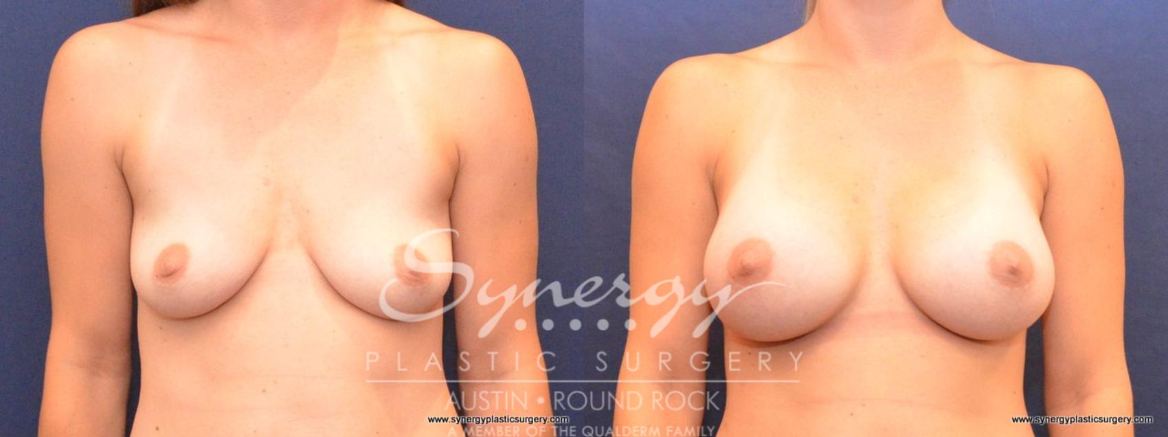 Before & After Breast Augmentation Case 410 View #1 View in Round Rock, TX