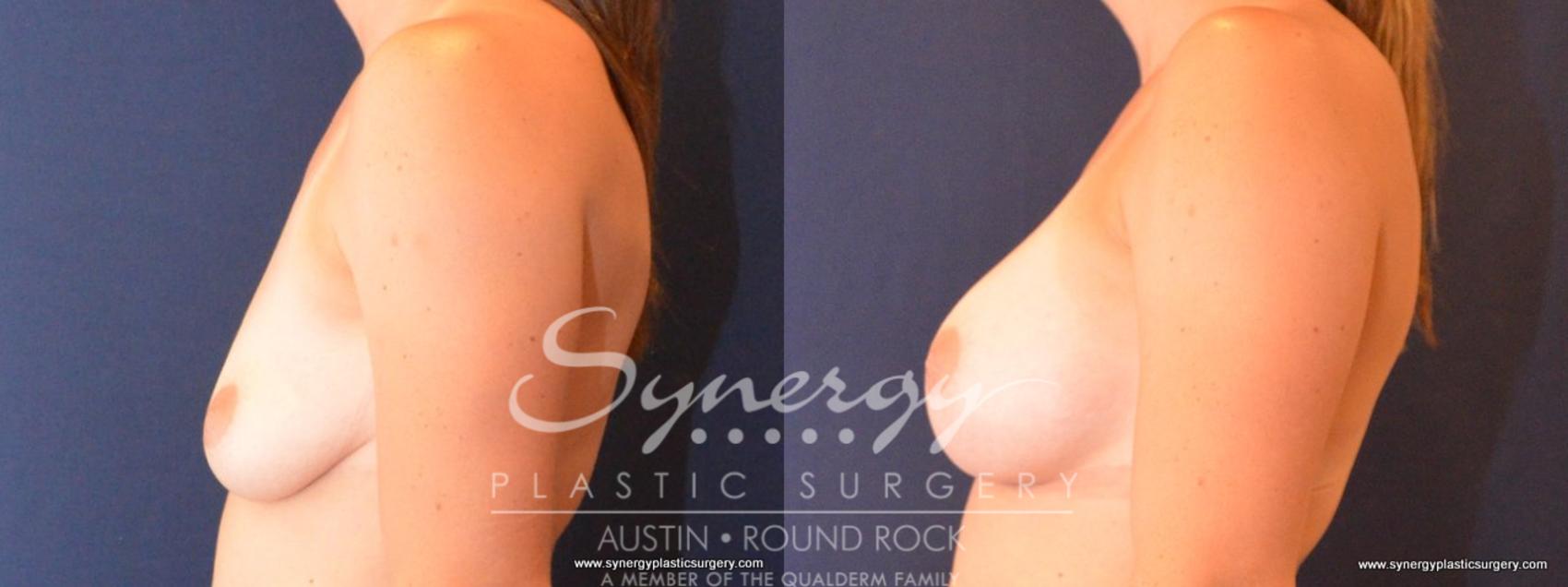 Before & After Breast Augmentation Case 410 View #2 View in Round Rock, TX