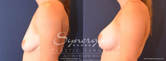 Before & After Breast Augmentation Case 410 View #2 View in Austin, TX