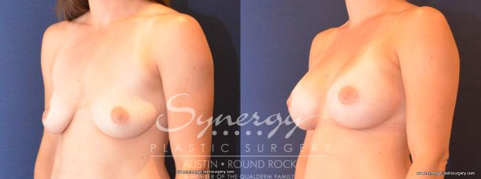 Before & After Breast Augmentation Case 410 View #3 View in Austin, TX