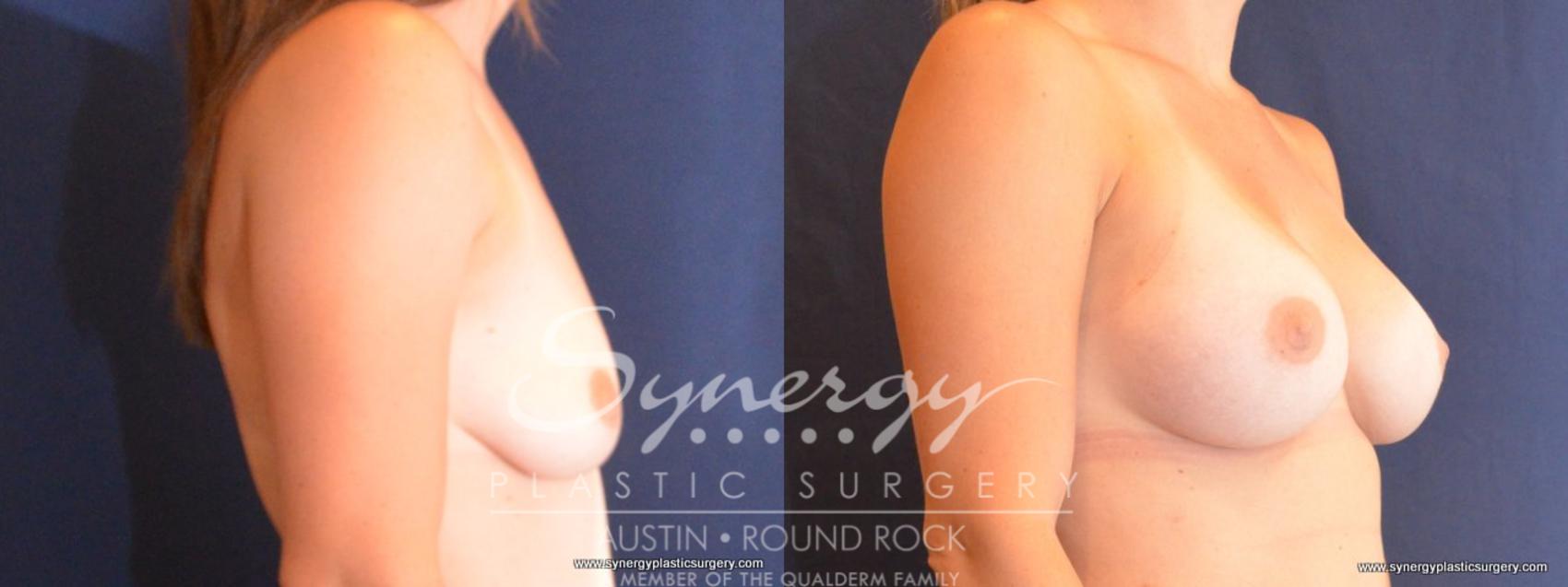 Before & After Breast Augmentation Case 410 View #4 View in Round Rock, TX