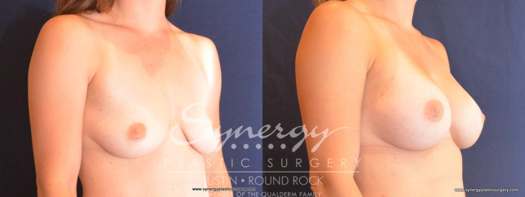 Before & After Breast Augmentation Case 410 View #5 View in Round Rock, TX