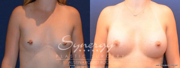 Before & After Breast Augmentation Case 411 View #1 View in Austin, TX