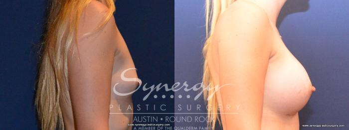 Before & After Breast Augmentation Case 411 View #2 View in Austin, TX