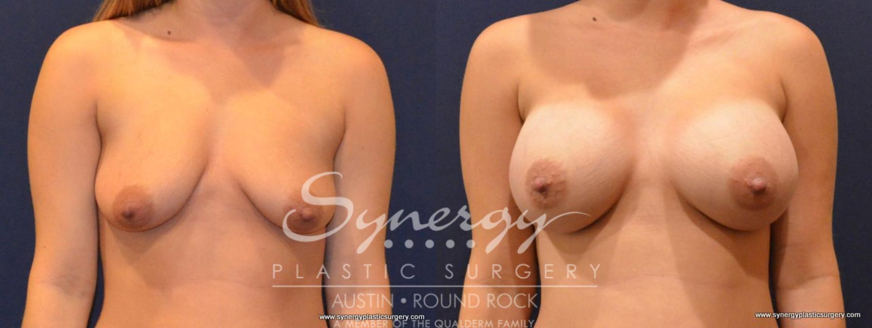 Before & After Breast Augmentation Case 413 View #1 View in Austin, TX