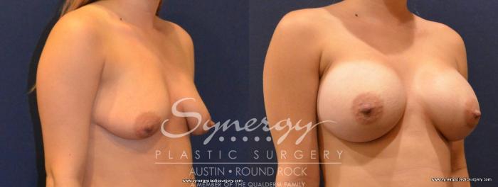 Before & After Breast Augmentation Case 413 View #2 View in Austin, TX