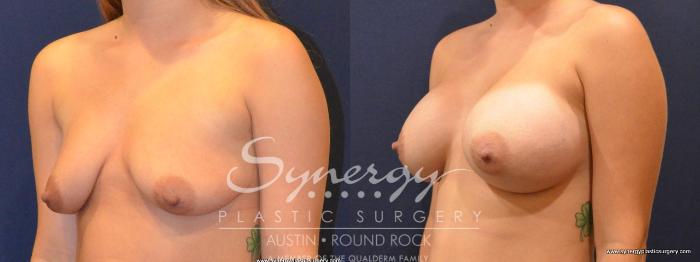 Before & After Breast Augmentation Case 413 View #3 View in Austin, TX