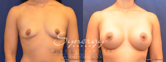 Before & After Breast Augmentation Case 416 View #1 View in Austin, TX