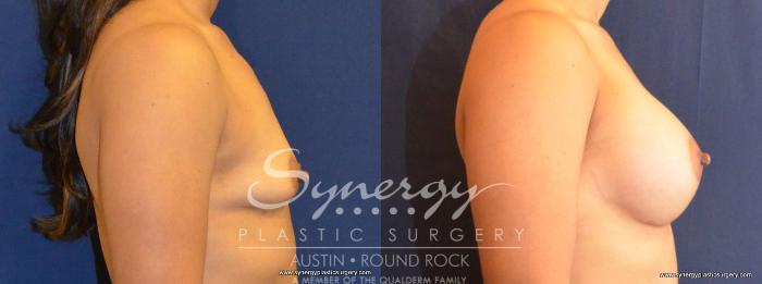 Before & After Breast Augmentation Case 416 View #2 View in Austin, TX