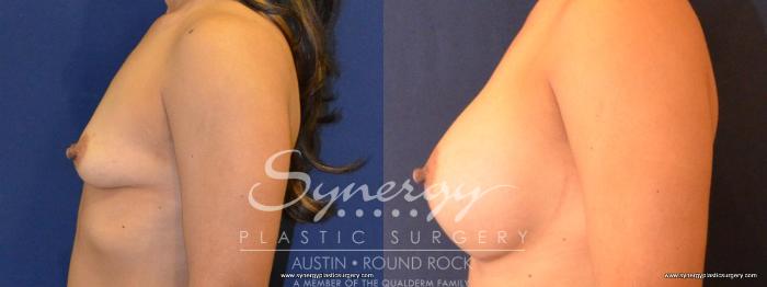 Before & After Breast Augmentation Case 416 View #4 View in Austin, TX