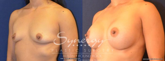Before & After Breast Augmentation Case 416 View #5 View in Austin, TX