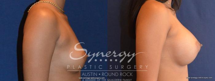Before & After Breast Augmentation Case 417 View #1 View in Austin, TX