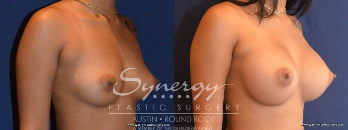 Before & After Breast Augmentation Case 417 View #2 View in Austin, TX