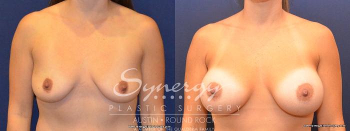 Before & After Breast Augmentation Case 422 View #1 View in Austin, TX