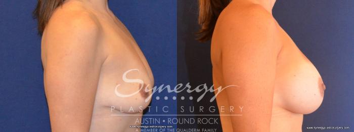 Before & After Breast Augmentation Case 422 View #2 View in Austin, TX