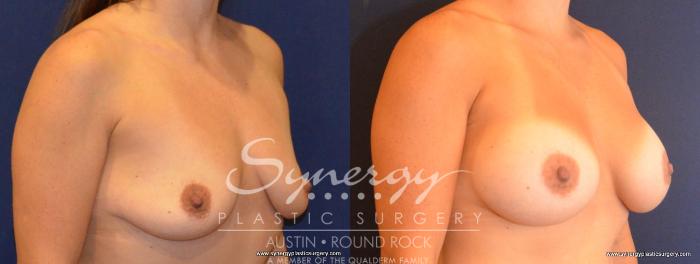 Before & After Breast Augmentation Case 422 View #3 View in Austin, TX