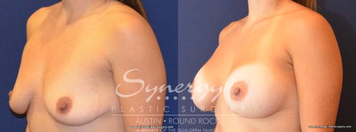 Before & After Breast Augmentation Case 422 View #5 View in Austin, TX