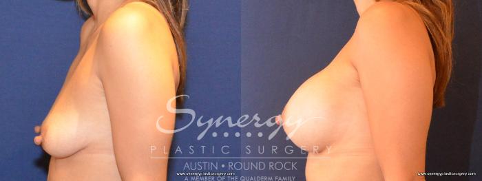 Before & After Breast Augmentation Case 423 View #2 View in Austin, TX