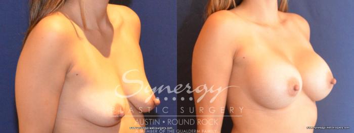 Before & After Breast Augmentation Case 423 View #4 View in Austin, TX
