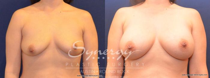 Before & After Breast Augmentation Case 424 View #1 View in Austin, TX