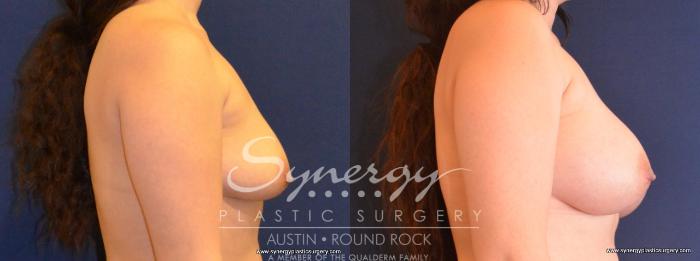 Before & After Breast Augmentation Case 424 View #2 View in Austin, TX