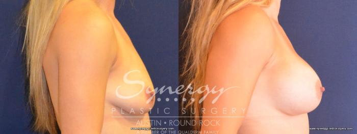 Before & After Breast Augmentation Case 425 View #2 View in Austin, TX