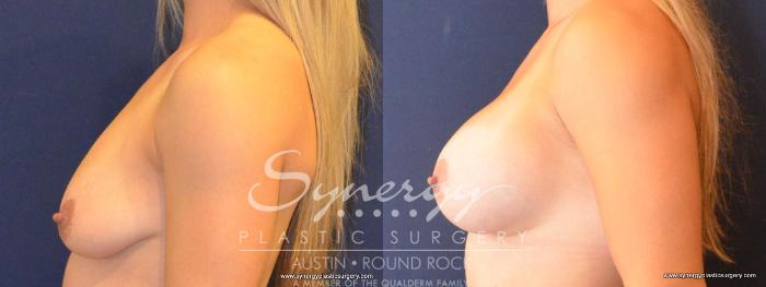 Before & After Breast Augmentation Case 425 View #3 View in Austin, TX
