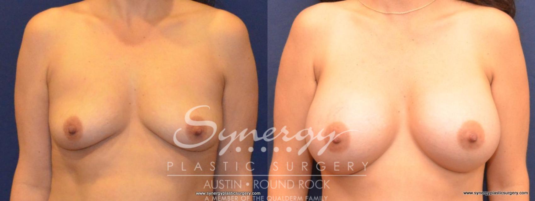 Before & After Breast Augmentation Case 427 View #1 View in Austin, TX