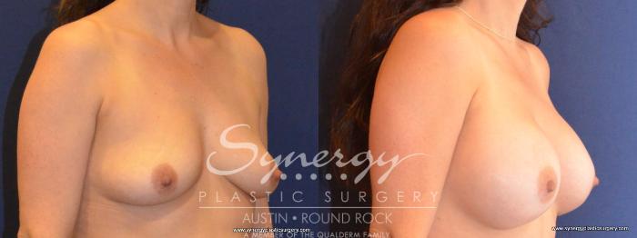 Before & After Breast Augmentation Case 427 View #2 View in Austin, TX