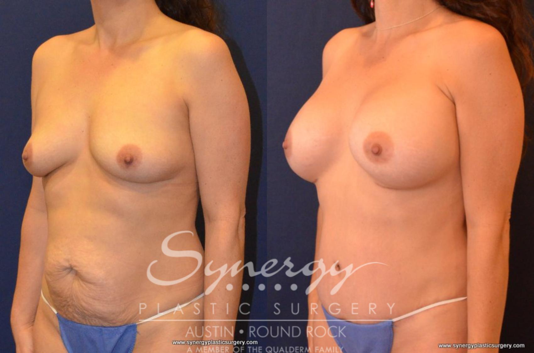 Before & After Breast Augmentation Case 428 View #1 View in Round Rock, TX