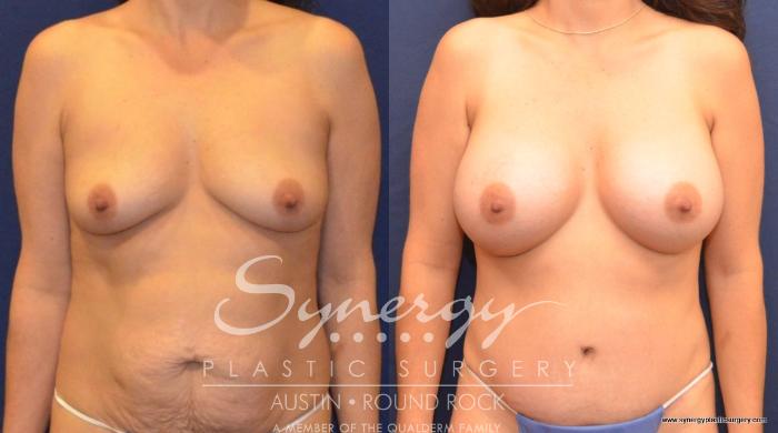 Before & After Breast Augmentation Case 428 View #2 View in Round Rock, TX