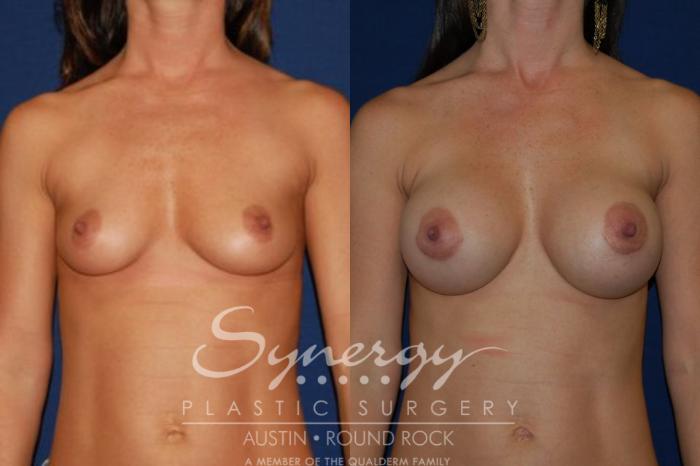Before & After Breast Augmentation Case 43 View #1 View in Austin, TX