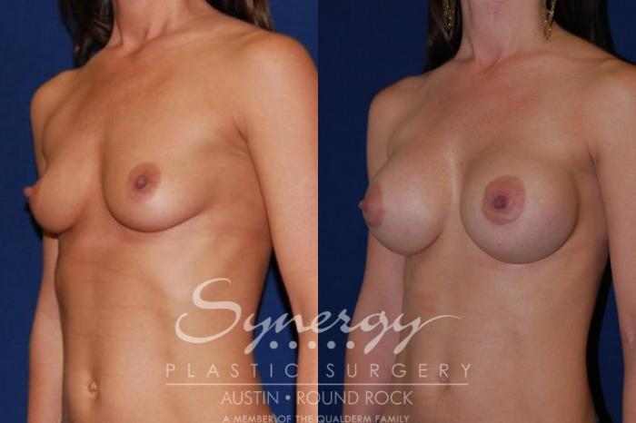 Before & After Breast Augmentation Case 43 View #2 View in Austin, TX