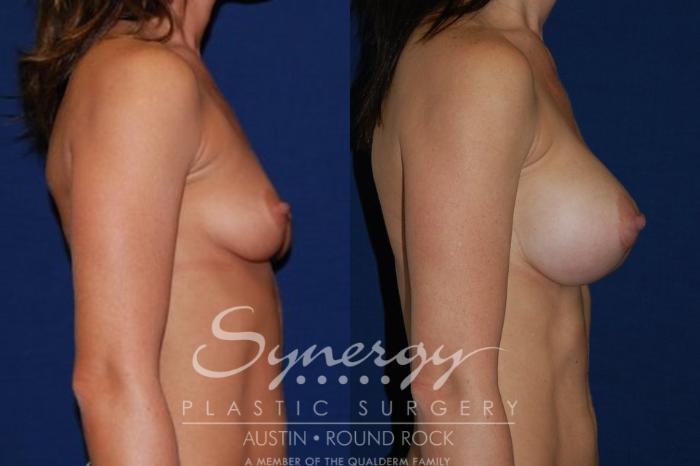 Before & After Breast Augmentation Case 43 View #3 View in Austin, TX
