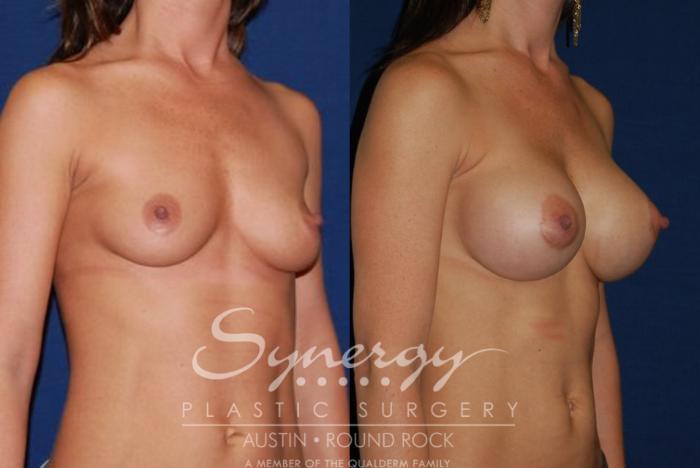 Before & After Breast Augmentation Case 43 View #4 View in Austin, TX