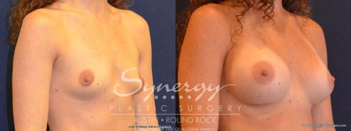 Before & After Breast Augmentation Case 431 View #2 View in Austin, TX