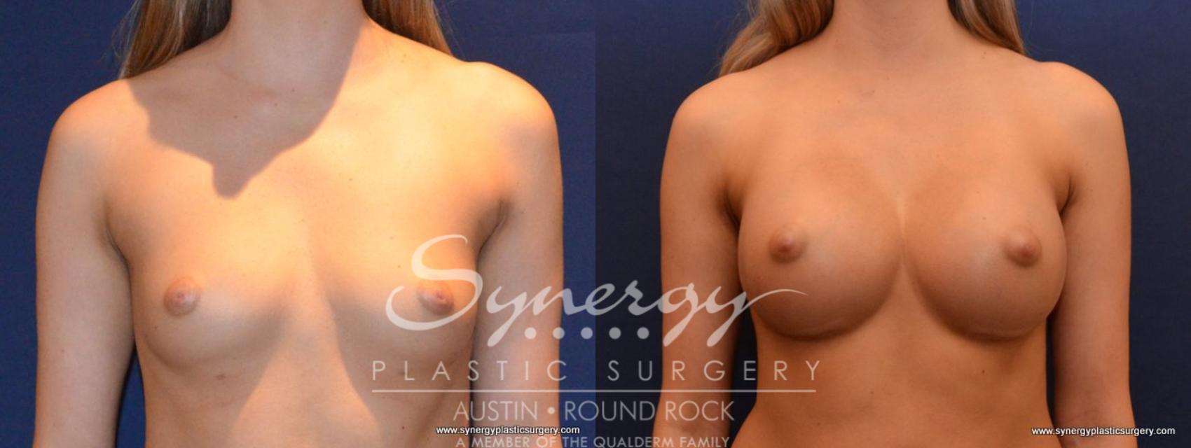 Before & After Breast Augmentation Case 435 View #1 View in Austin, TX