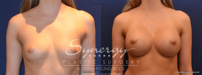 Before & After Breast Augmentation Case 435 View #1 View in Austin, TX